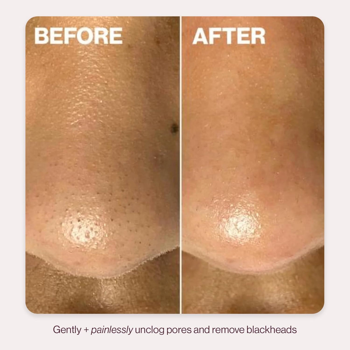 DERMAFLASH DERMAPORE+ Skin Care Device, Ultrasonic 2-in-1 Pore Extractor and Skincare Infuser, Seafoam
